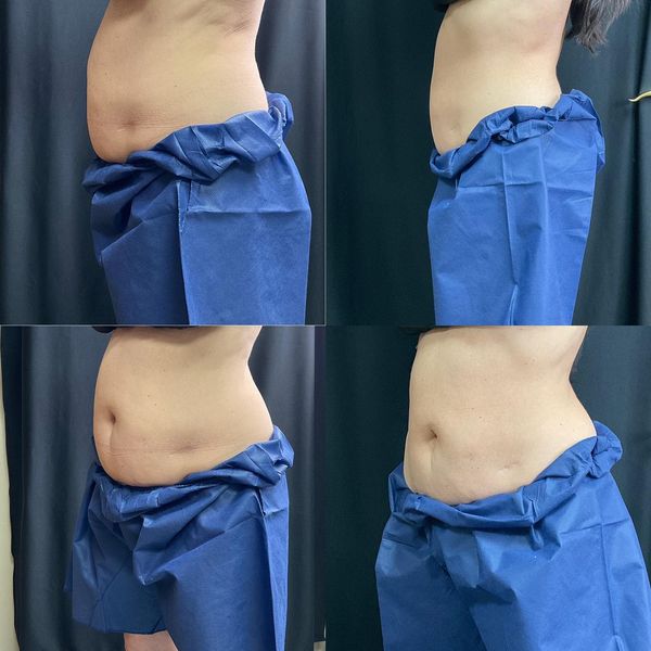 coolsculpting-before-and-after