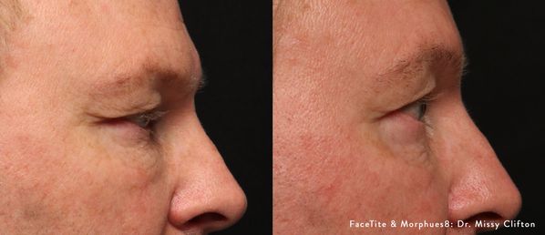 MC_FaceTiteMorpheus8_1c_PeriorbitalRightProfile